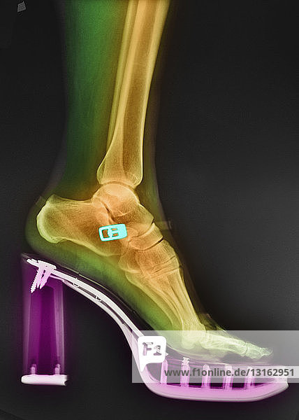 farbiges Röntgenbild eines Fußes in einem hochhackigen Schuh