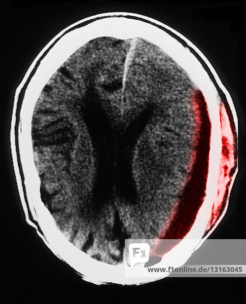 Kopf-CT-Untersuchung mit subduralem Hämatom  Atrophie