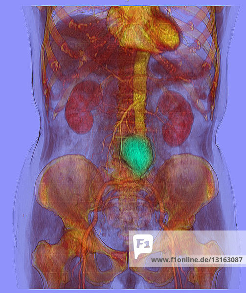 CT-Scan-Bild  das ein abdominales Aortenaneurysma zeigt