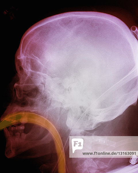 Röntgenbild des Schädels mit Intubation