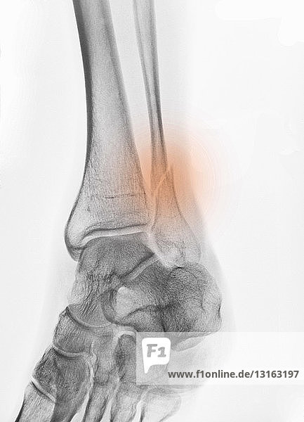 x-ray of a fracture of the distal fibula