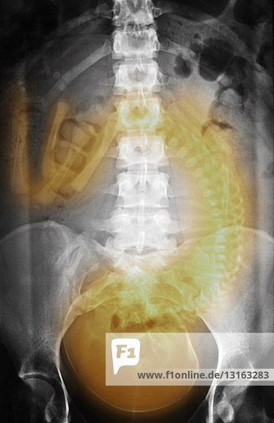 Röntgenaufnahme des Abdomens bei einem normalen Fötus mit voller Schwangerschaft