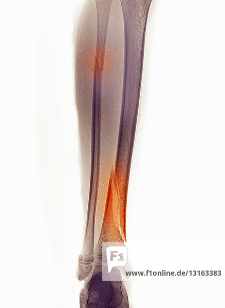 Röntgenbild des Beins mit Fraktur von Fibula und Tibia