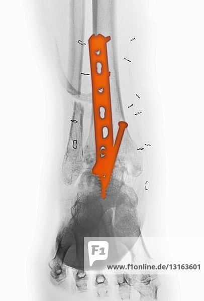 x-ray of an ankle fracture
