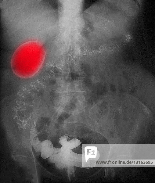 X-ray of abdomen showing porcelain gall bladder