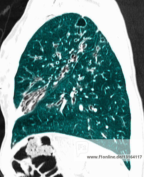 CT scan of chest showing cystic fibrosis