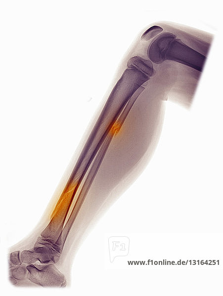 Röntgenbild des Beins mit Fraktur von Fibula und Tibia