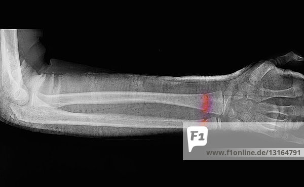 Röntgenbild der Unterarmfraktur eines 11-jährigen Jungen