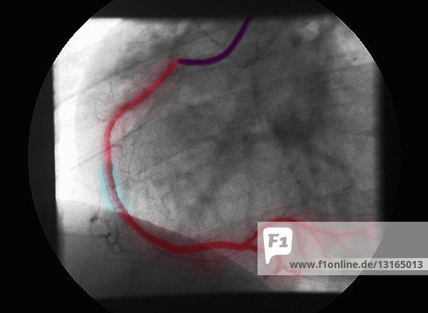 Angiogramm der RCA mit Stenose und Reparatur