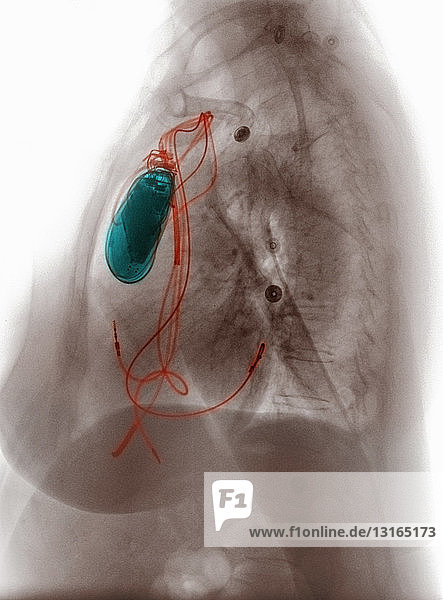 Brust-Röntgenbild mit Herzschrittmacher