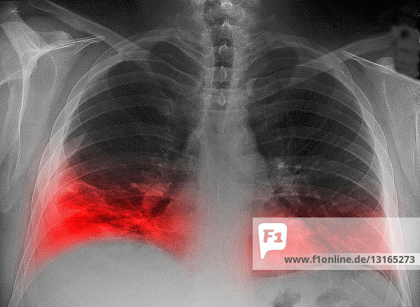 CXR eines Rauchers mit Infiltrat einer Lungenentzündung in der Lunge