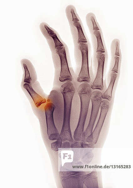 Röntgenbild der Hand mit Daumenluxation
