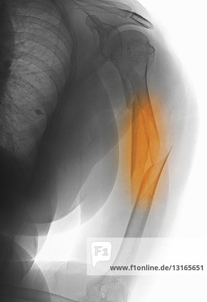 Röntgenbild  das eine Trümmerfraktur des Humerus zeigt