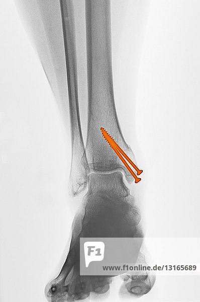 x-ray of an ankle fracture