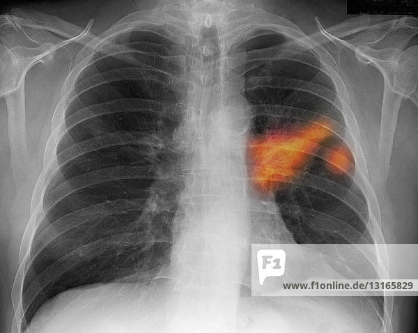 Thorax-Röntgenbild eines Rauchers mit Lungenkrebs