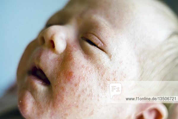 Newborn baby boy face with many red pimples caused by atopic dermatitis  Poland  Europe