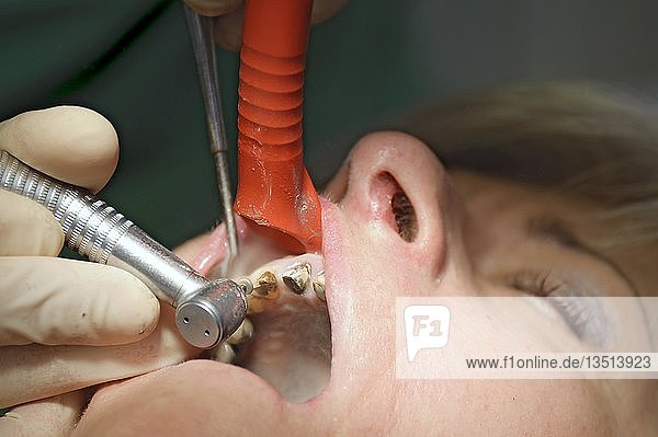 Zahnarzt schleift Zahnstümpfe