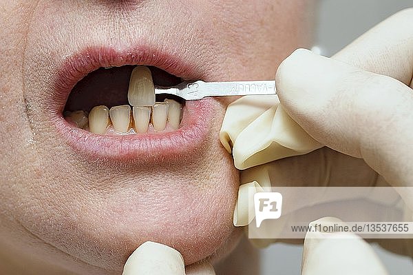 Farbliche Anpassung der Zähne eines Patienten während einer Zahnbehandlung