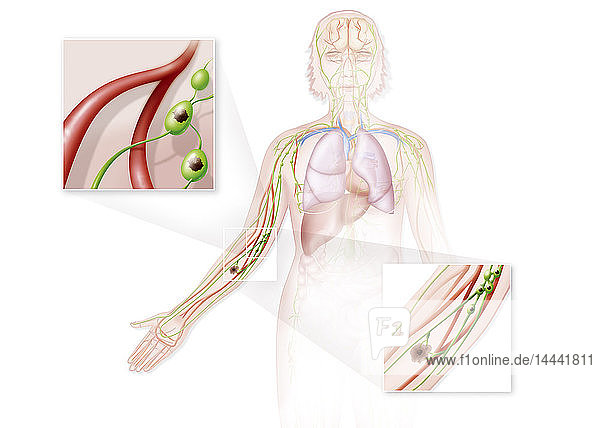 Illustration eines Melanoms im Stadium 3 am Arm. Im Stadium 3 sind die umliegenden Drüsen von Metastasen des Tumors betroffen. Oben links  Drüsen im Arm  die von Metastasen betroffen sind. Unten rechts  Blick auf den Tumor  das Lymphsystem in der Nähe und die von Metastasen betroffenen Drüsen.