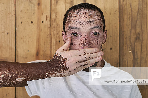 Junger Mann mit Vitiligo bedeckt seinen Mund mit der Hand