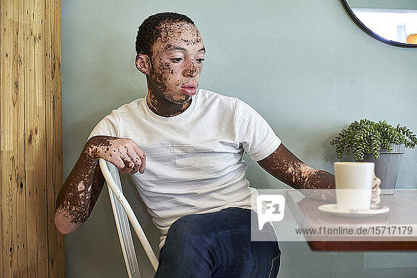 Junger Mann mit Vitiligo bei einer Tasse Kaffee in einer Cafeteria