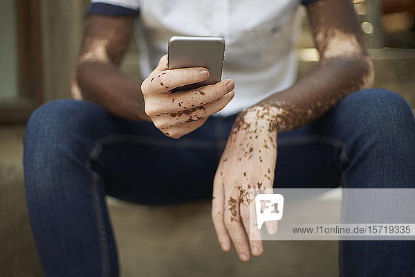 Junger Mann mit Vitiligo nutzt Smartphone