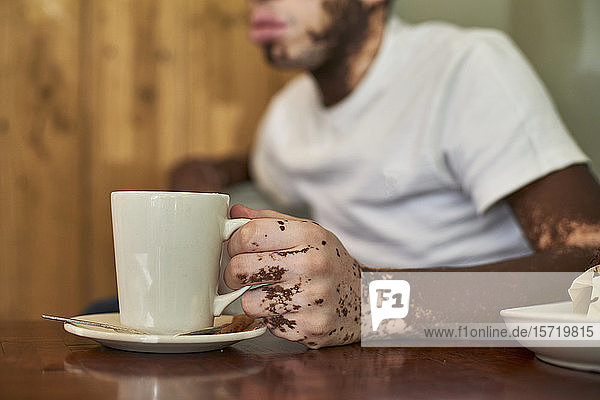 Nahaufnahme der Hand eines Mannes mit Vitiligo  der eine Kaffeetasse hält