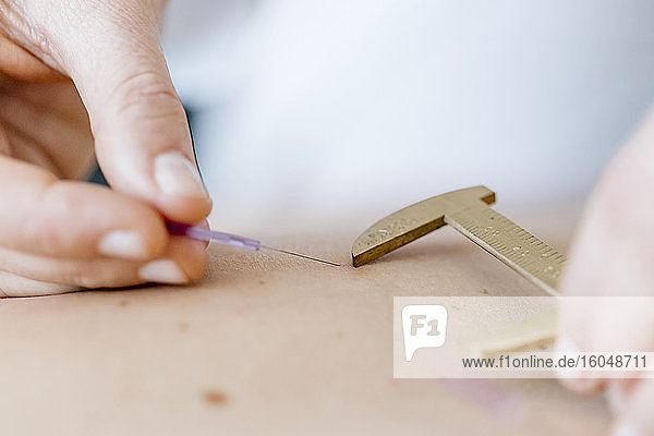 Akupunktur  Hand mit Schieblehre auf dem Rücken mit Akupunkturnadel während der Behandlung