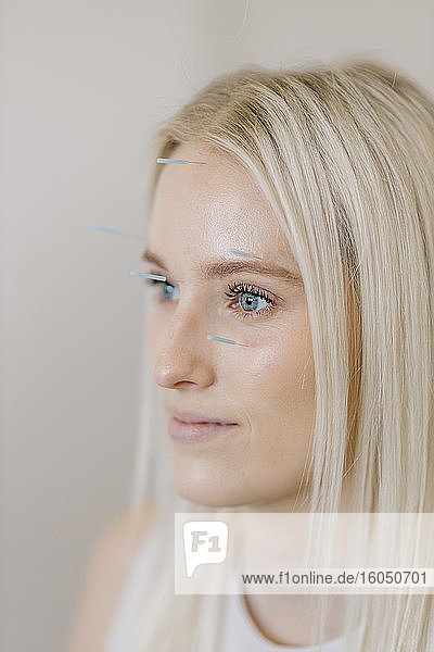 Akupunktur  junge Frau mit Akupunkturnadel bei Behandlung im Gesicht