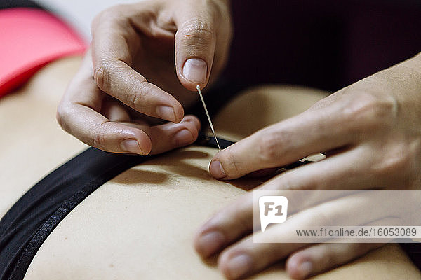 Physiotherapeutin mit Akupunkturnadel während der Behandlung