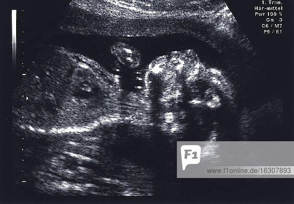 Deutschland  Ultraschallbild eines fünf Monate alten weiblichen Fötus