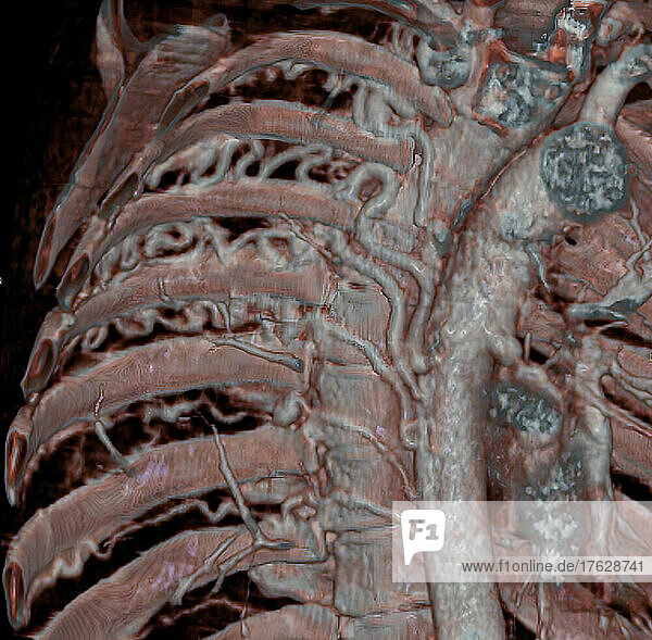 Large intercostal arteries  visible in a CT scan  developed to compensate pulmonary blood flow due to a congenital heart defect characterized by atresia of pulmonary arteries (small or absent pulmonary arteries). 3D CT scan.