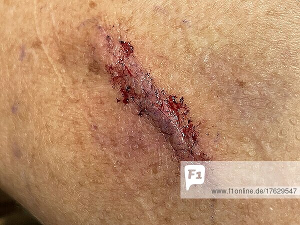 Excision of a lipoma on the upper back of a 72-year-old woman  one-day absorbable suture.