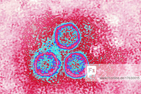 HPV (Human papillomavirusvirus). The human papillomavirus or papillomavirus is the cause of sexually transmitted infections (condyloma acuminata which can induce cancer of the cervix). They are also the cause of skin infections: warts. View produced from a transmission electron microscopy image. Viral diameter approximately: 55 nm.