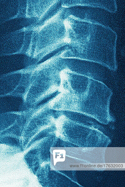 Osteoarthritis of the cervical vertebrae C5-C6. spinal x-ray in sagittal view.