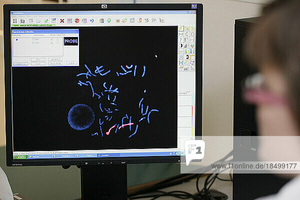 Cytogenetics laboratory  prenatal diagnosis by medical imaging FISH (Fluorescent In Situ Hybridization / Hybridization par Fluorescence In Situ). Painting of certain chromosomes showing a translocation.