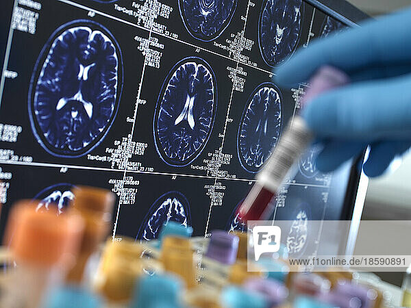 United Kingdom  High Wycombe  Alzheimer's and Dementia Research  Scientist holding a blood sample during a clinical trial with a MRI on screen