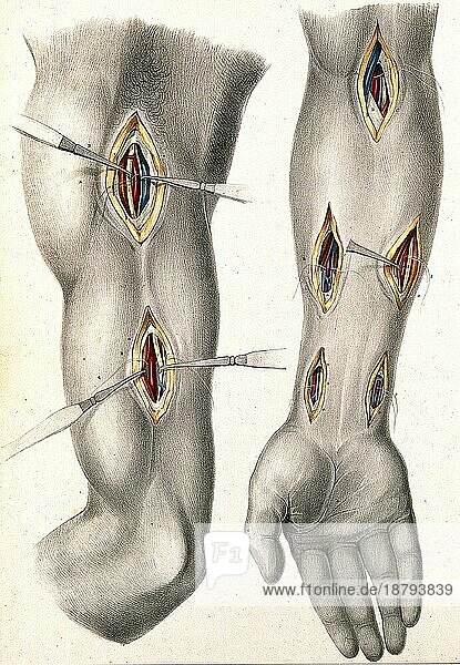 Medizin  Anatomie  Chirurgie der Arterien des Arms  zwei Abbildungen mit Schnitten am Ober- und Unterarm  mit chirurgischen Instrumenten  die Arterien anzeigen  um 1834  Historisch  digital restaurierte Reproduktion von einer Vorlage aus dem 19. Jahrhundert