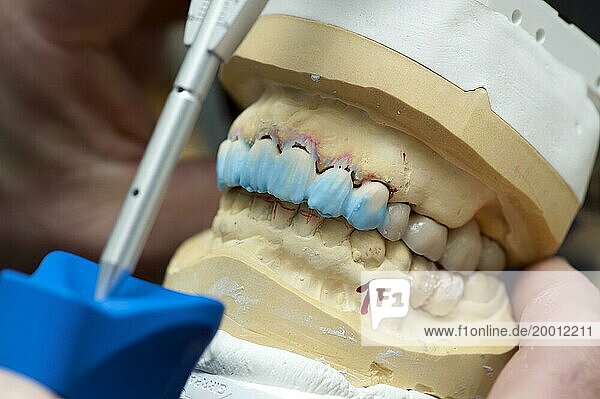 Coloured ceramic crowns in the upper jaw model