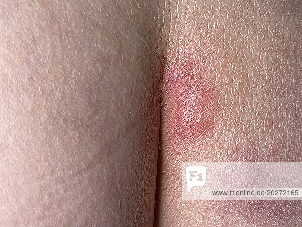 Recovery of herpes on a herpes scar. Bottom right an old scar.