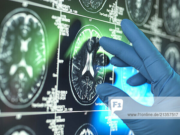 Hand of scientist wearing surgical glove examining MRI brain scan of patient