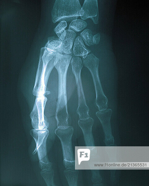 Medical Radiography. X-Ray of human hand & wrist.